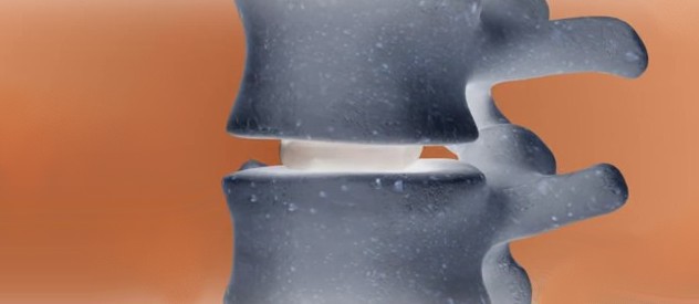 EPITROCHOID MOVEMENT AROUND INTERVERTEBRAL DISK